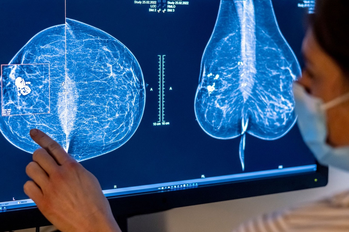 Die Möglichkeiten zur Mammographie für die Früherkennung von Brustkrebs soll ausgeweitet werden.