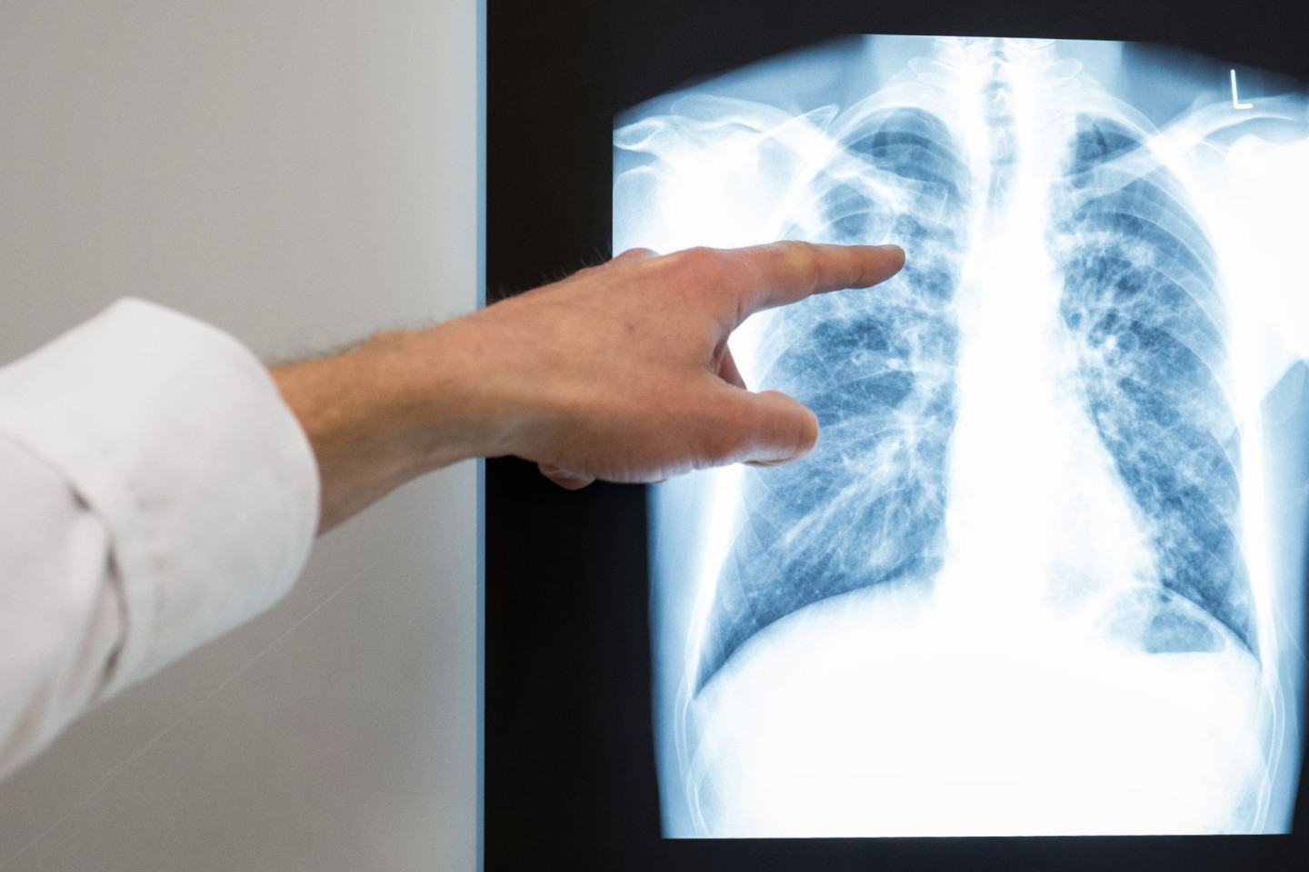 Ein Arzt zeigt auf das Röntgenbild einer Lunge. Die Corona-Maßnahmen belasten den Kampf gegen die Tuberkulose.