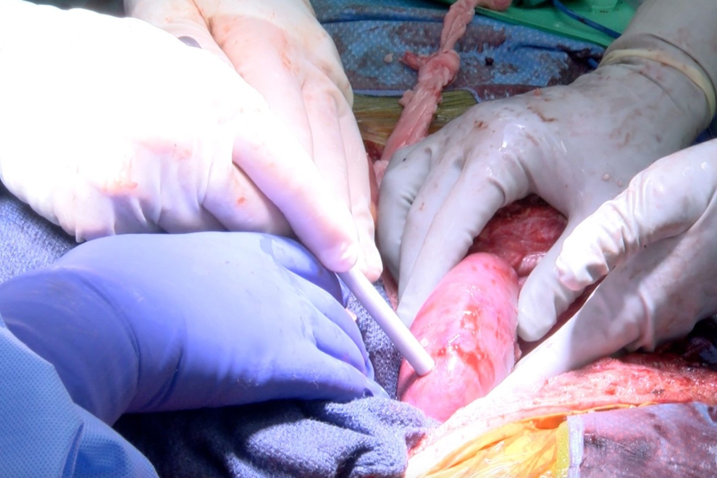 Gut zwei Wochen nach der Transplantation eines Schweineherzens berichten US-Mediziner von der Übertragung von Schweinenieren auf einen Menschen.