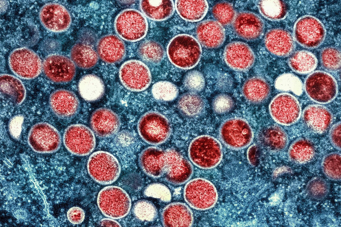 Partikel des Affenpockenvirus (rot) in einer infizierten Zelle (blau). Die Affenpocken-Fälle in Europa nehmen zu.